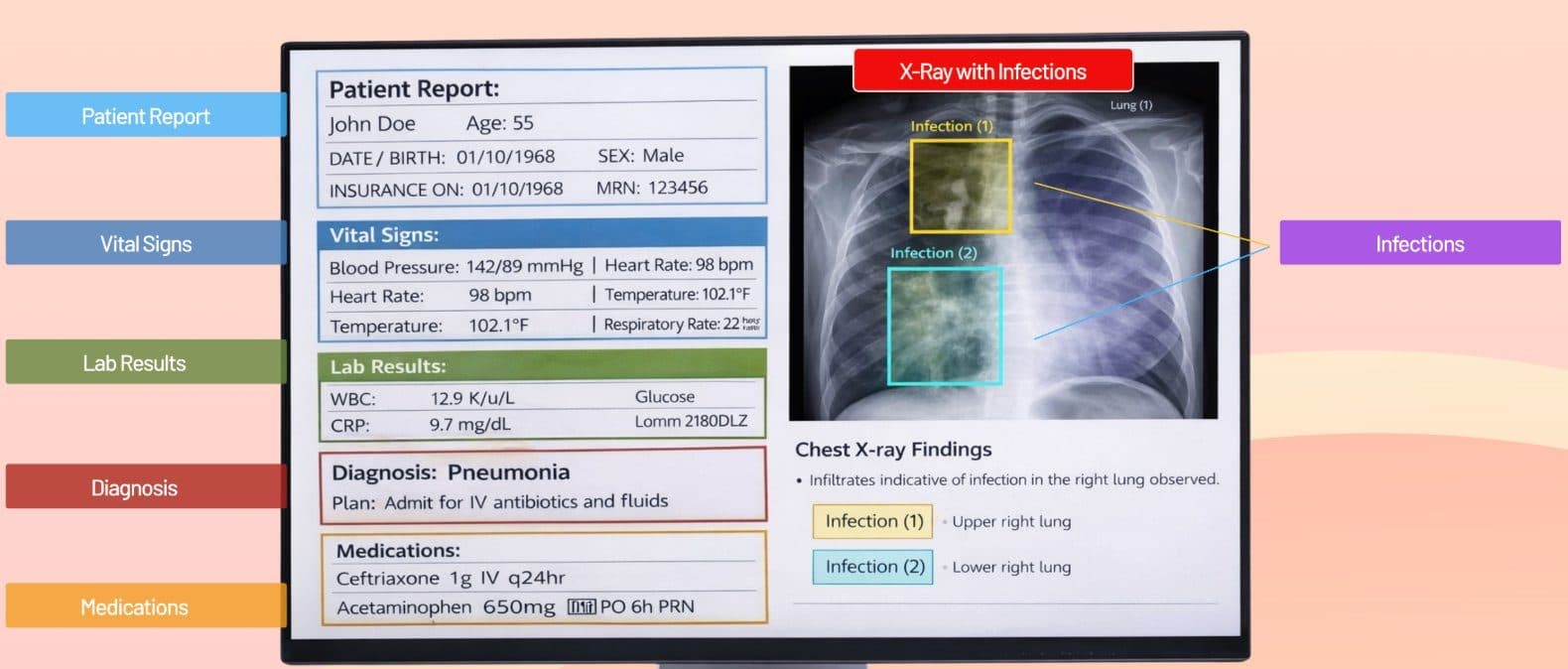 Multimodal clinical annotation combining structured patient report extraction with chest X-ray infection bounding boxes